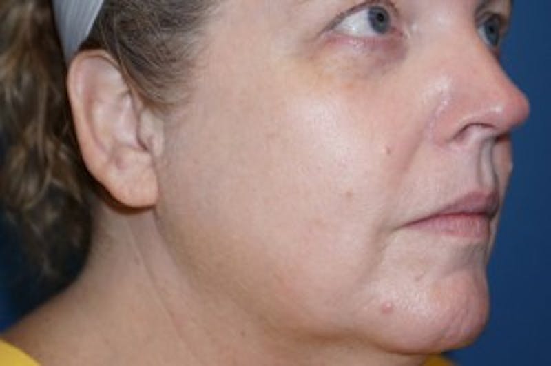 Halo Laser Before & After Gallery - Patient 93894541 - Image 4