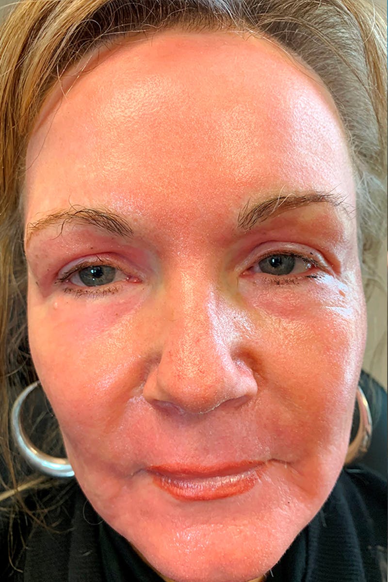 Contour TRL Before & After Gallery - Patient 93894543 - Image 2