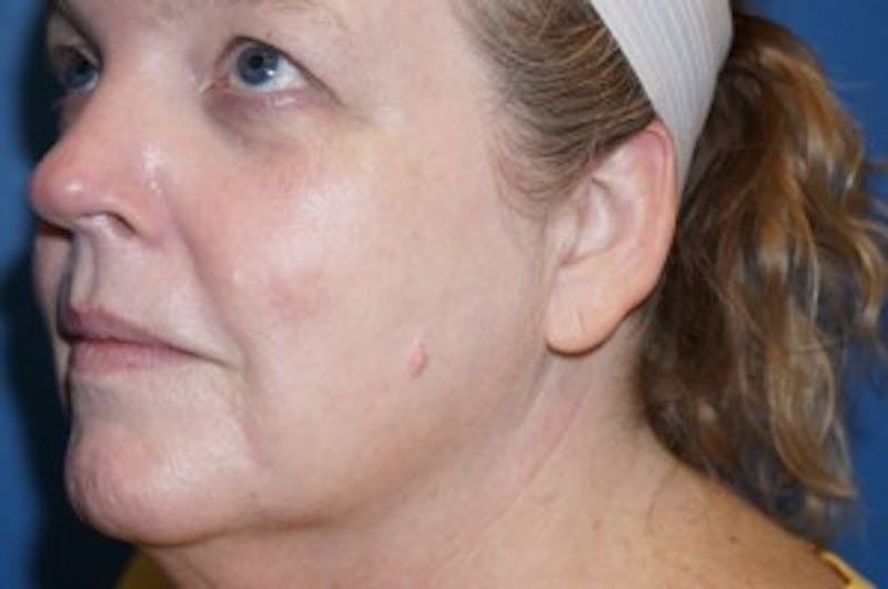 Halo Laser Before & After Gallery - Patient 93894541 - Image 6
