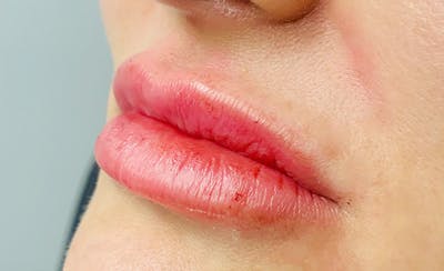 Lip Filler Before & After Gallery - Patient 93894544 - Image 2
