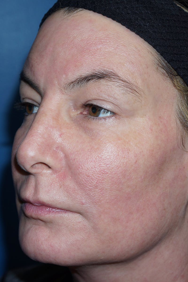Contour TRL Before & After Gallery - Patient 93894559 - Image 2