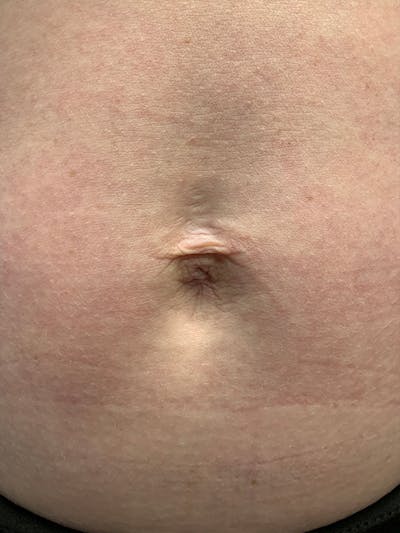 Halo Laser Before & After Gallery - Patient 93894557 - Image 1