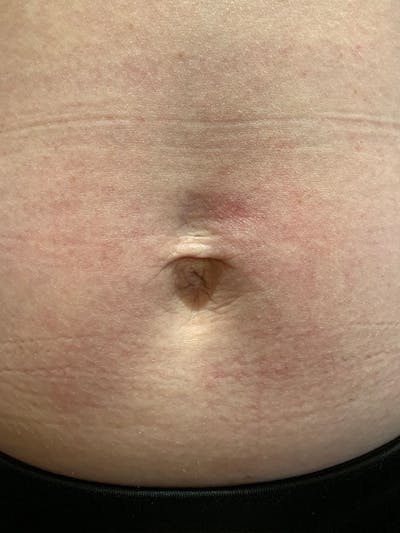 Halo Laser Before & After Gallery - Patient 93894557 - Image 2