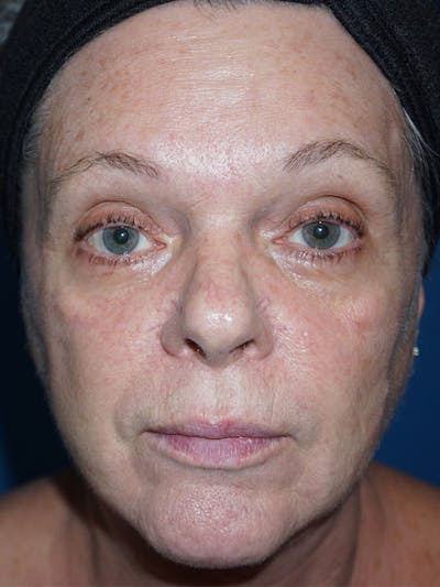 Halo Laser Before & After Gallery - Patient 93894613 - Image 1