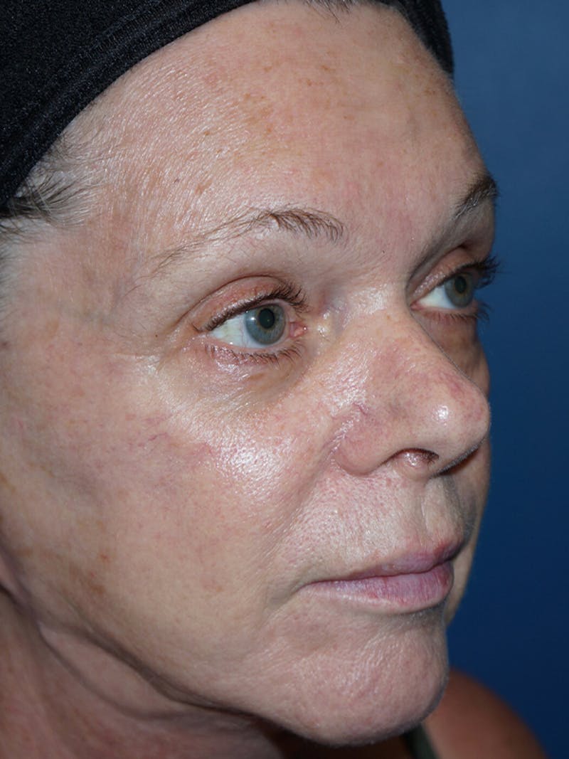 Halo Laser Before & After Gallery - Patient 93894613 - Image 3