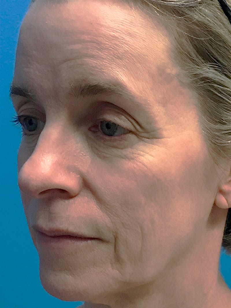 Halo Laser Before & After Gallery - Patient 93894614 - Image 1