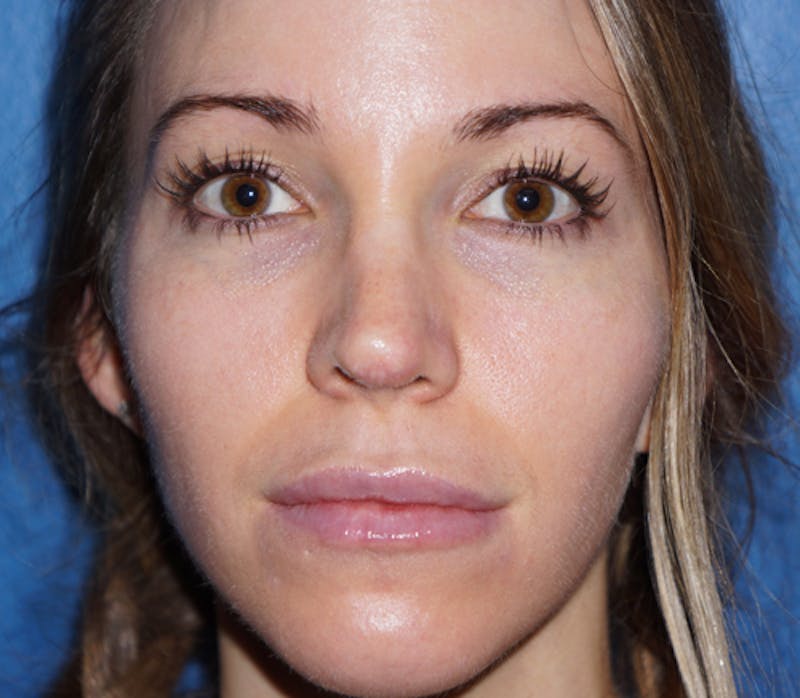 Cheek Filler Before & After Gallery - Patient 93894648 - Image 2