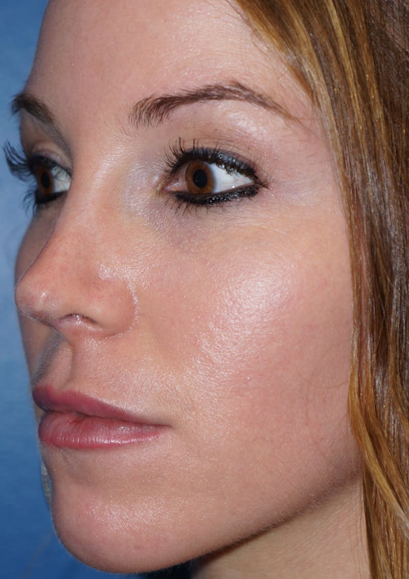Cheek Filler Before & After Gallery - Patient 93894648 - Image 3