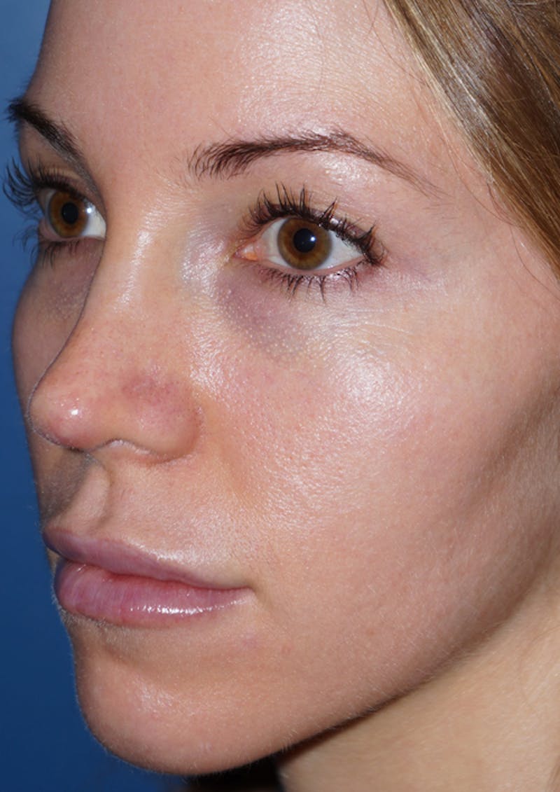 Cheek Filler Before & After Gallery - Patient 93894648 - Image 4