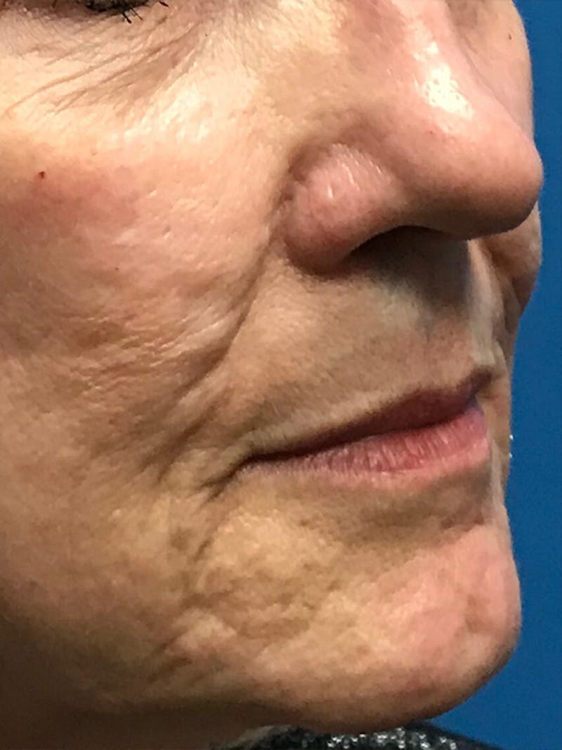 Halo Laser Before & After Gallery - Patient 93894678 - Image 7