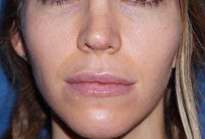 Non-Surgical Nose Job Before & After Gallery - Patient 93894679 - Image 2