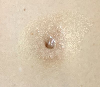 Medical Tattoo Before & After Gallery - Patient 93894701 - Image 2