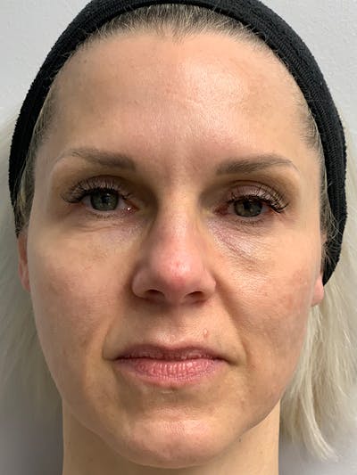 AquaGold Fine Touch Before & After Gallery - Patient 93894762 - Image 1