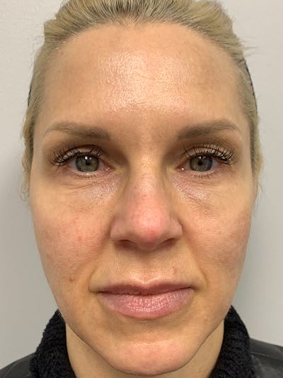AquaGold Fine Touch Before & After Gallery - Patient 93894762 - Image 2