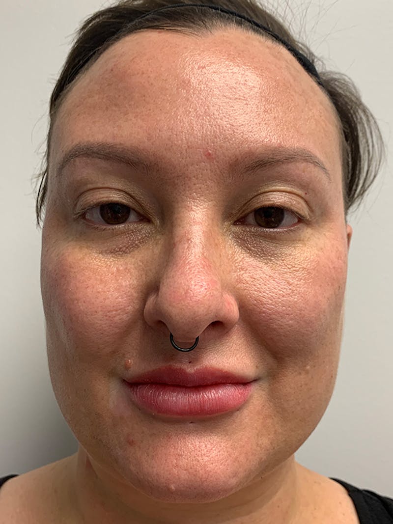 Chemical Peels Before & After Gallery - Patient 93898058 - Image 1