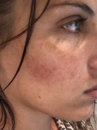 Chemical Peels Before & After Gallery - Patient 93898077 - Image 1