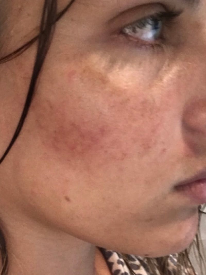 Chemical Peels Before & After Gallery - Patient 93898077 - Image 3