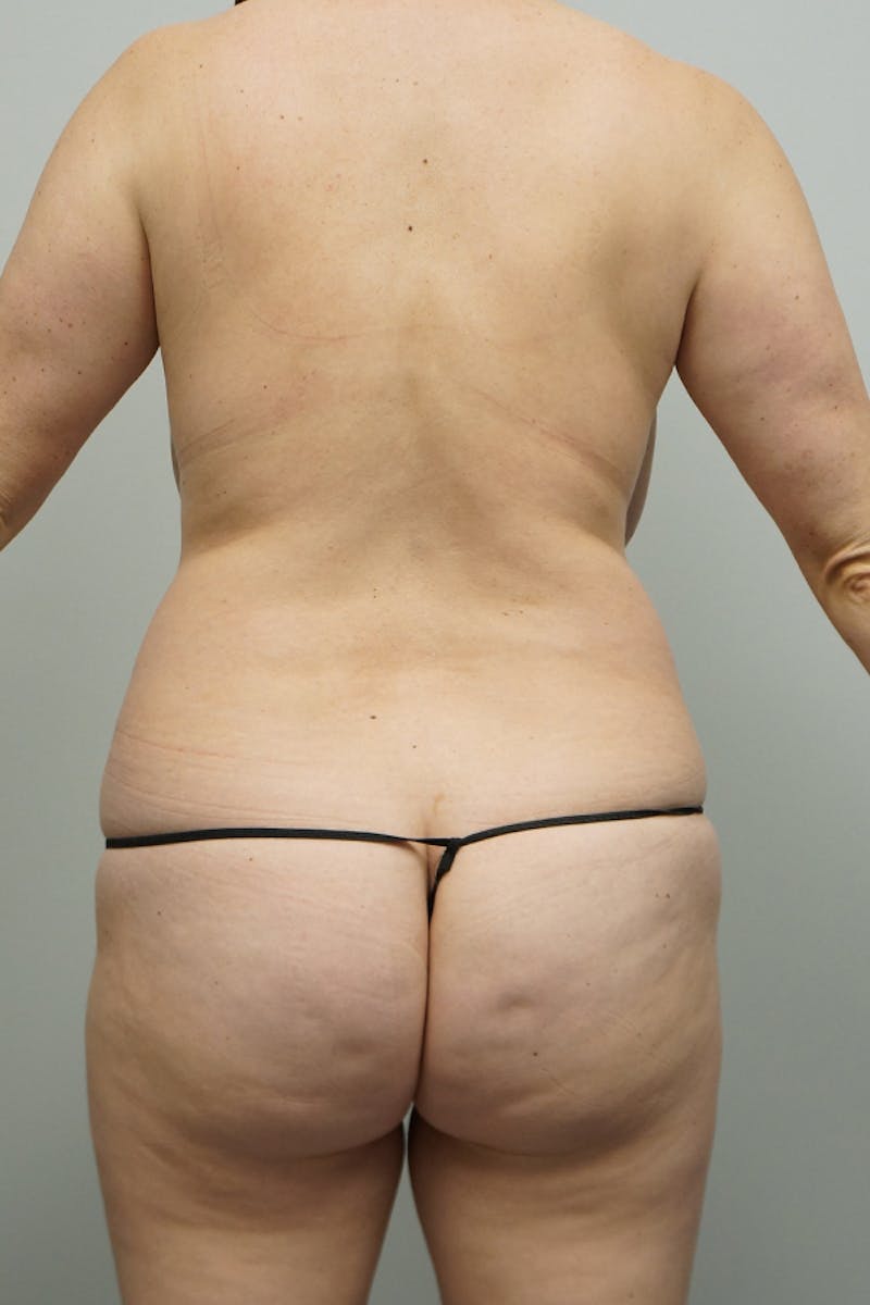 Liposuction Before & After Gallery - Patient 93898669 - Image 5