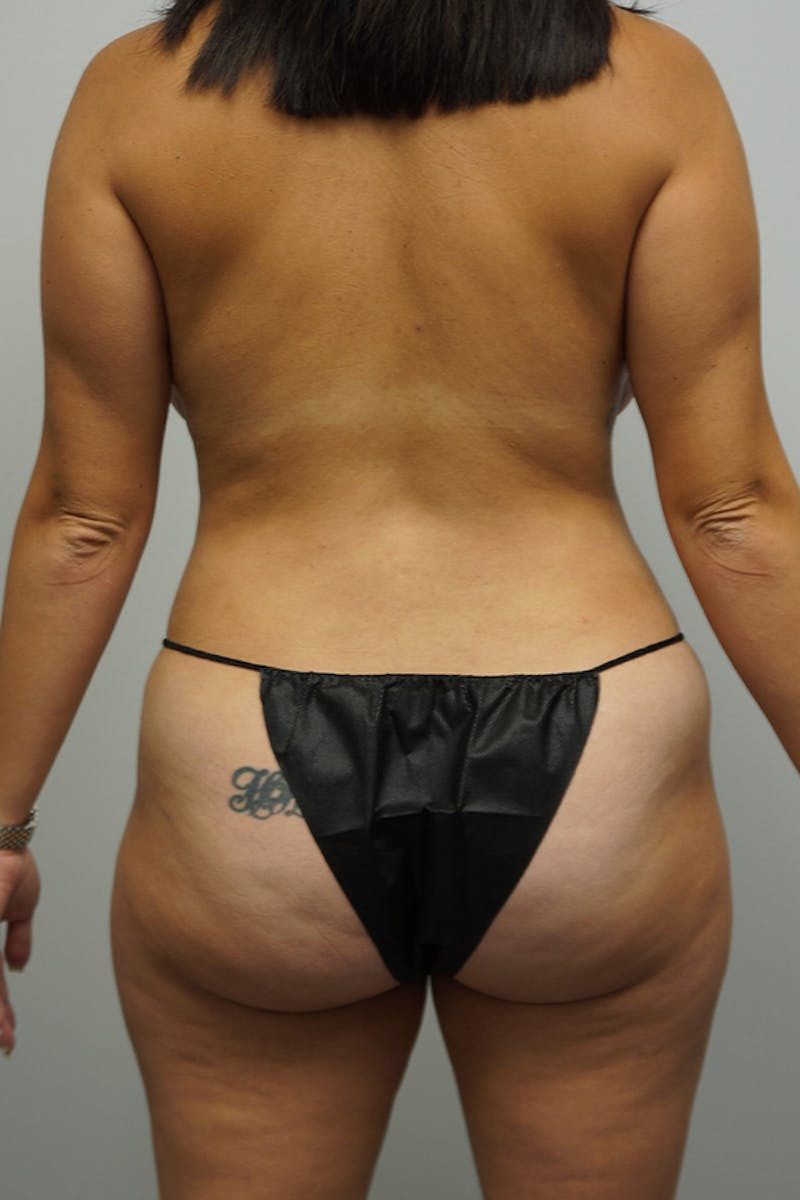 Liposuction Before & After Gallery - Patient 93898689 - Image 8