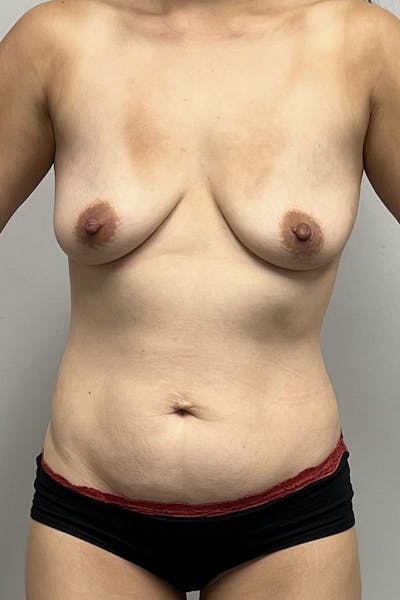 Liposuction Before & After Gallery - Patient 93898706 - Image 1