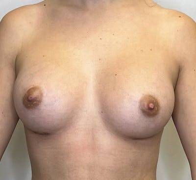 Breast Augmentation Before & After Gallery - Patient 93898720 - Image 2