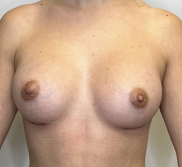 Dr. Lind Houston Breast Augmentation Gallery Results