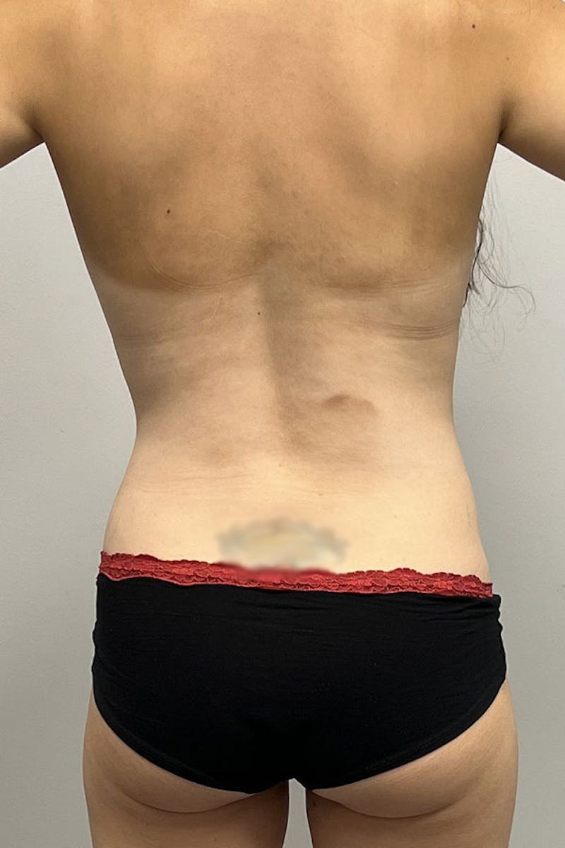 Liposuction Before & After Gallery - Patient 93898706 - Image 7
