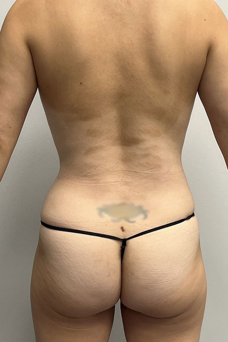 Liposuction Before & After Gallery - Patient 93898706 - Image 8
