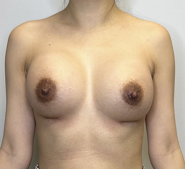 Beautiful Breast Augmentation Before & After Photos