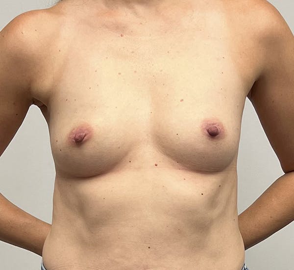 Breast Augmentation Before & After Result Photos