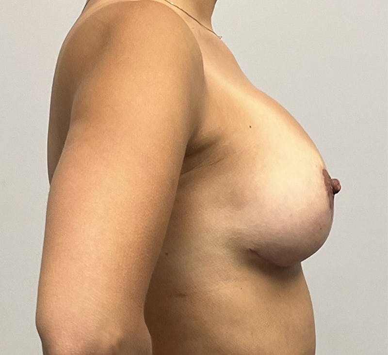 Liposuction Before & After Gallery - Patient 93898787 - Image 6
