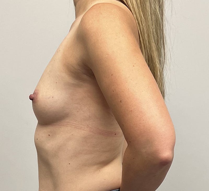 Breast Augmentation Before & After Gallery - Patient 93898788 - Image 5