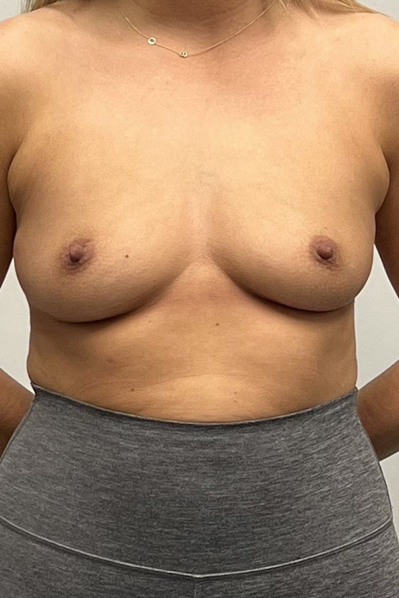 Breast Augmentation Before & After Gallery - Patient 494011 - Image 1