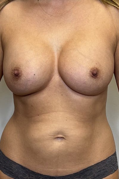 Breast Augmentation Before & After Gallery - Patient 494011 - Image 2