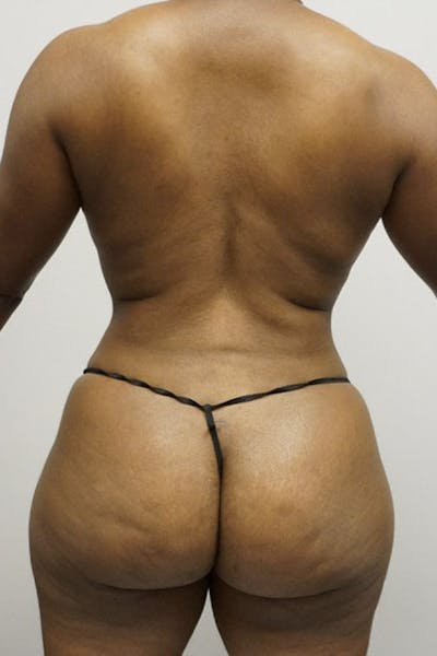 Liposuction Before & After Gallery - Patient 93898815 - Image 2