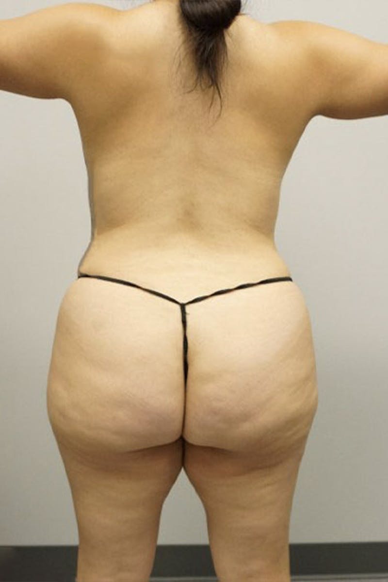 Liposuction Before & After Gallery - Patient 93898846 - Image 3