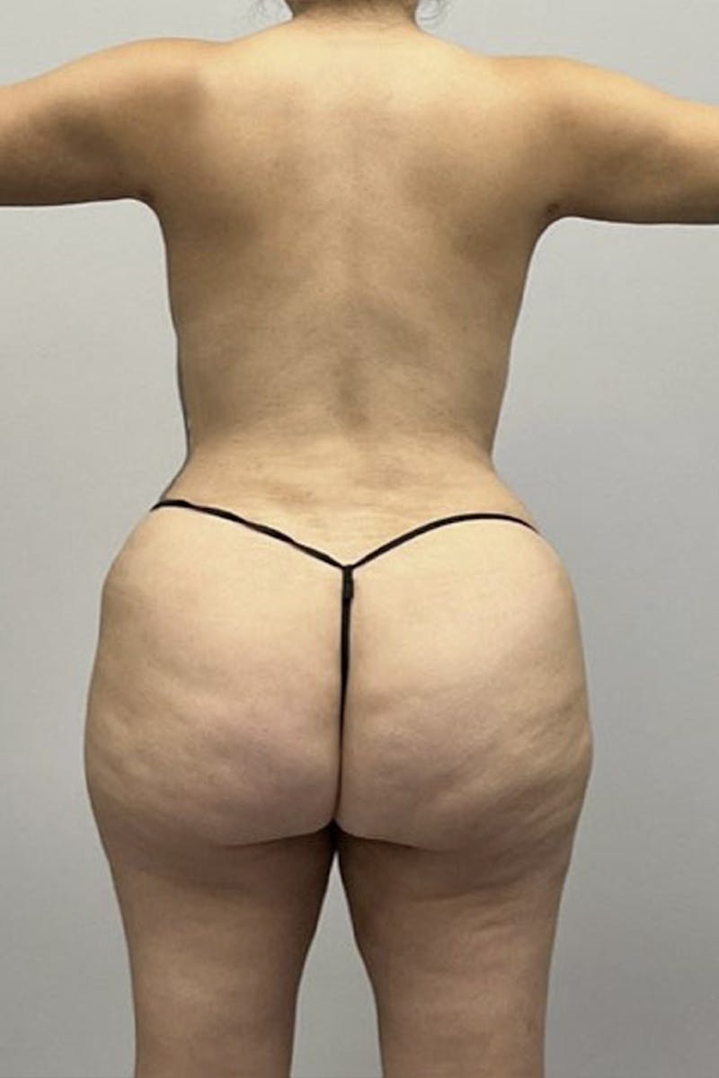 Liposuction Before & After Gallery - Patient 93898846 - Image 4