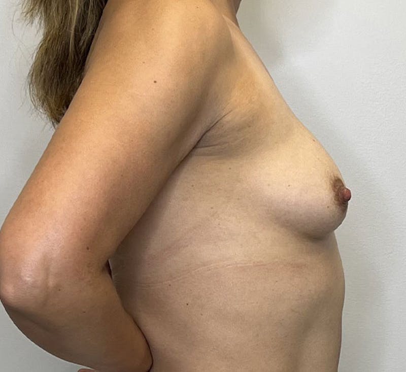 Breast Augmentation Before & After Gallery - Patient 93898844 - Image 5