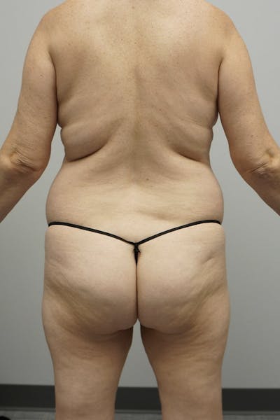 Liposuction Before & After Gallery - Patient 93898860 - Image 1