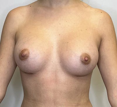 Breast Augmentation Before & After Gallery - Patient 93898862 - Image 2