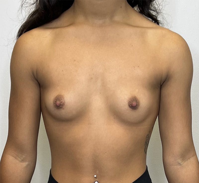 Breast Augmentation Before & After Gallery - Patient 93898913 - Image 1