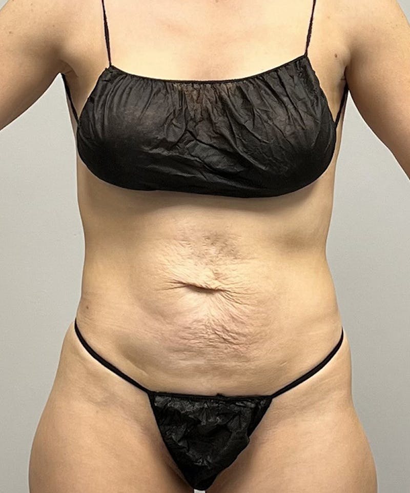 Tummy Tuck Before & After Gallery - Patient 93898887 - Image 1