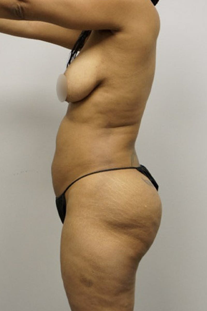 Liposuction Before & After Gallery - Patient 93898885 - Image 4