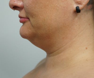 Liposuction Before & After Gallery - Patient 93898900 - Image 1