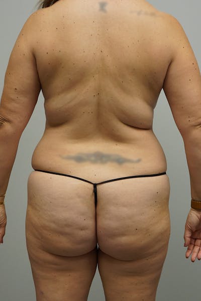 Liposuction Before & After Gallery - Patient 93898915 - Image 1