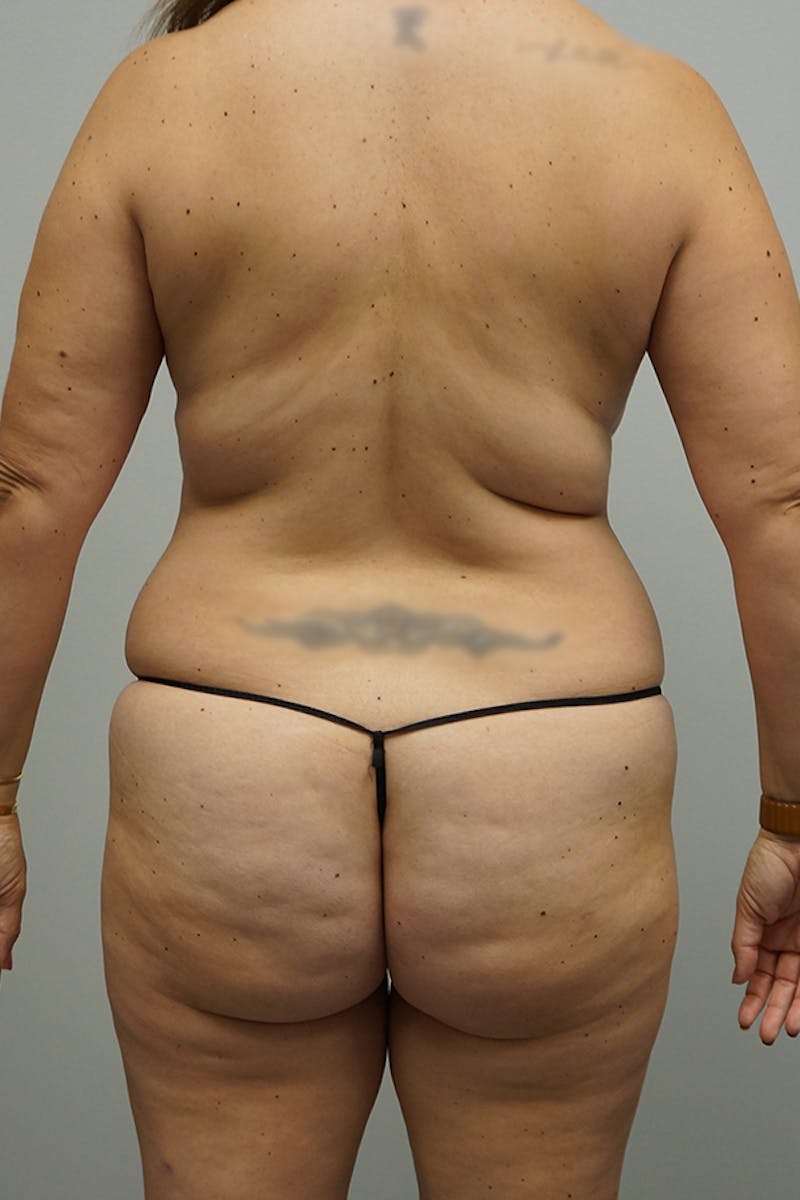 Liposuction Before & After Gallery - Patient 93898915 - Image 1
