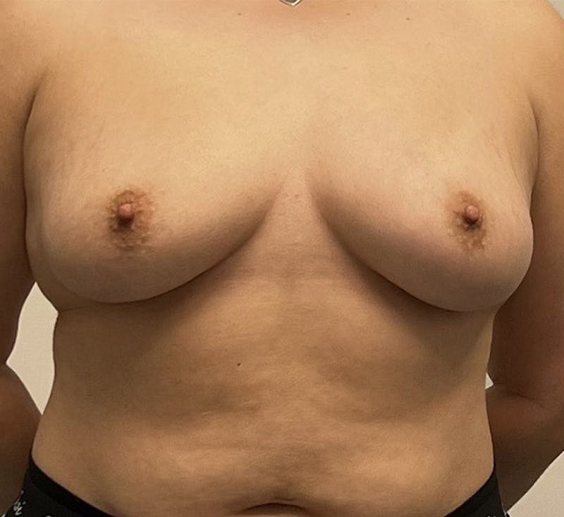 Breast Augmentation Before & After Gallery - Patient 93898917 - Image 1