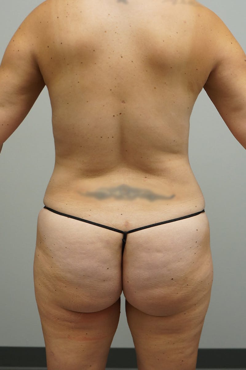 Liposuction Before & After Gallery - Patient 93898915 - Image 2