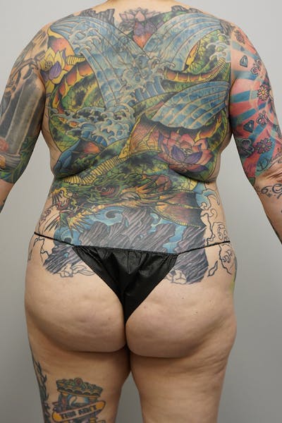 Liposuction Before & After Gallery - Patient 93898934 - Image 1