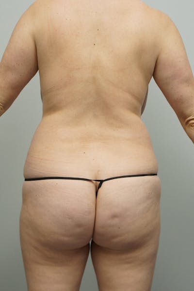 Liposuction Before & After Gallery - Patient 93898942 - Image 1